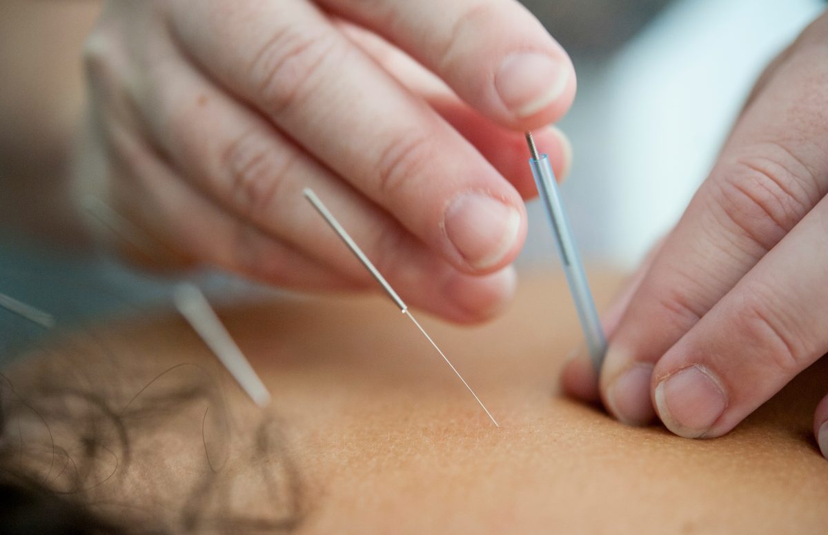 Acupuncture: Key Principles, Benefits, and Modern Medical Uses